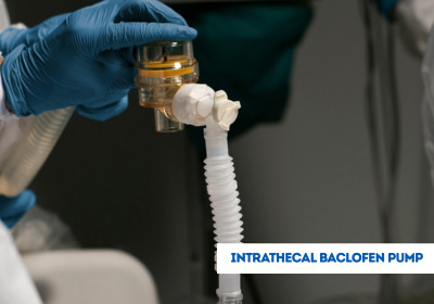 Intrathecal Baclofen Surgery Pump in India