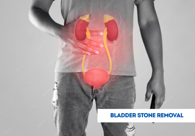 Bladder Stone Removal Surgery in India