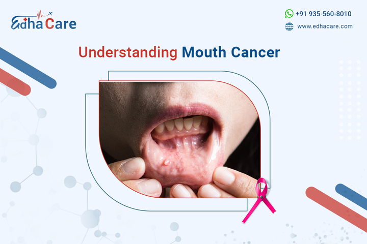 Common Symptoms Of Mouth Cancer