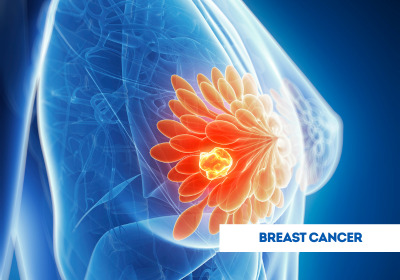Breast Cancer Treatment in India