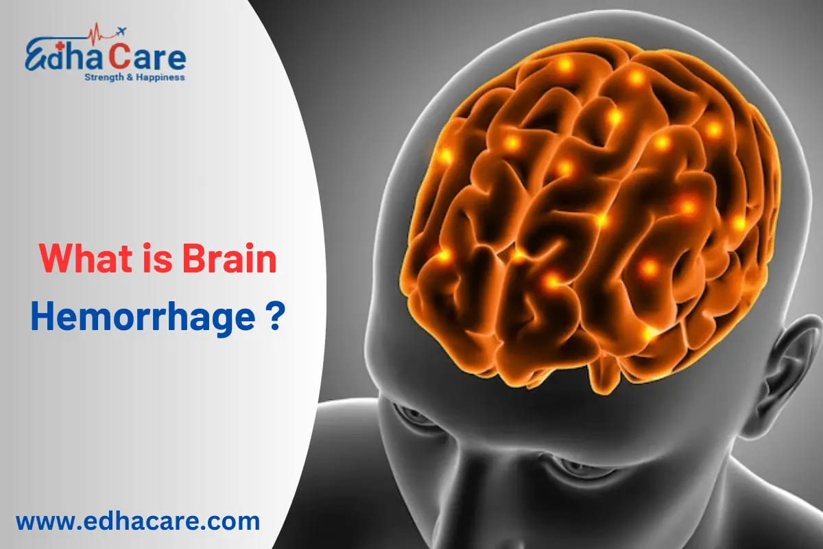 What is Brain Hemorrhage ? Causes & Treatment