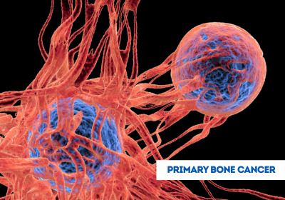 Primary Bone Cancer Treatment in India