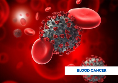 Blood Cancer Treatment in India