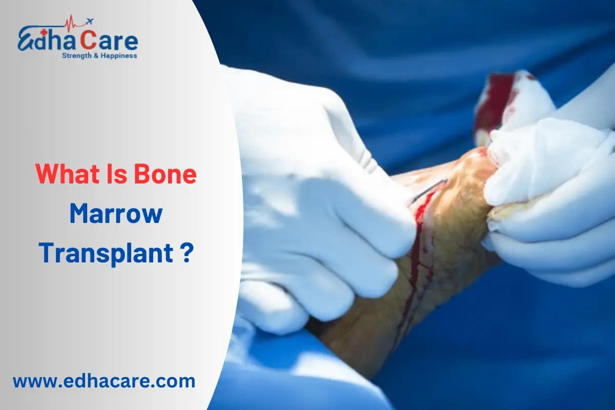 What Is Bone Marrow Transplant